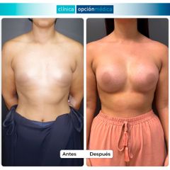 Aumento de pecho - Clínica Opción Médica