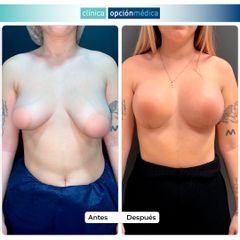 Mastopexia con asimetría - Clínica Opción Médica