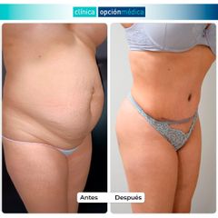 Abdominoplastia con liposucción - Clínica Opción Médica