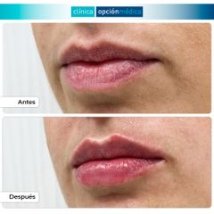 Aumento de labios - Clínica Opción Médica