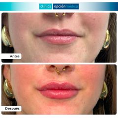 Aumento de labios - Clínica Opción Médica