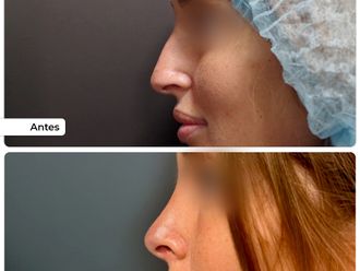 Rinoplastia antes y después - 876708