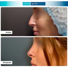 Rinoplastia - Clínica Opción Médica