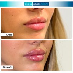 Aumento de labios - Clínica Opción Médica