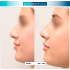 Rinomodelación - Clínica Opción Médica