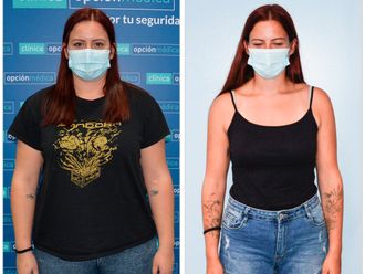 Balón gástrico antes y después - 876712