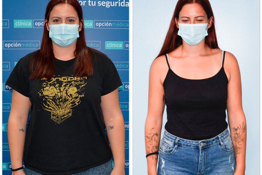 Balón gástrico antes y después - 876712