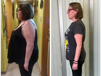 POSE Reducción de estómago antes y después - 876713