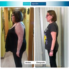 -40 kg con Reducción de Estómago - Clínica Opción Médica