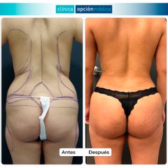 Liposucción con lipofilling - Clínica Opción Médica