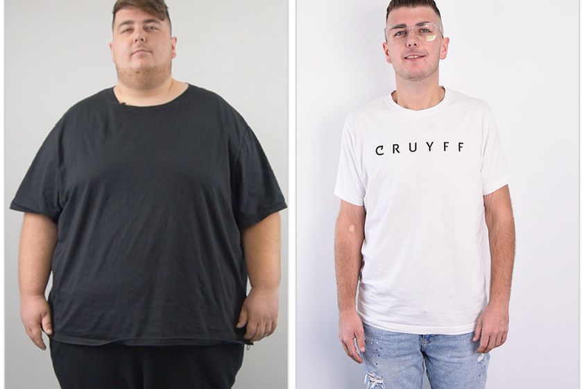 Manga gástrica antes y después - 876715