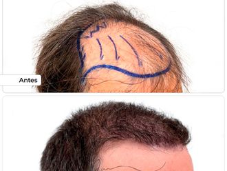 Microinjertos antes y después - 876722