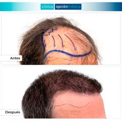 Microinjerto capilar - Clínica Opción Médica