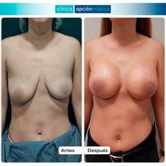 Corrección de asimetría - Clínica Opción Médica