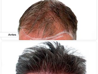 Microinjertos antes y después - 876751