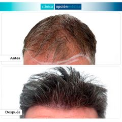Microinjerto capilar - Clínica Opción Médica