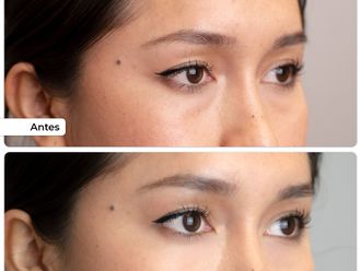 Eliminación ojeras antes y después - 876770