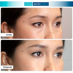 Eliminación de ojeras - Clínica Opción Médica