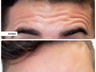 Eliminación arrugas antes y después - 876771