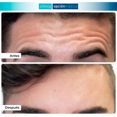 Eliminación de arrugas - Clínica Opción Médica