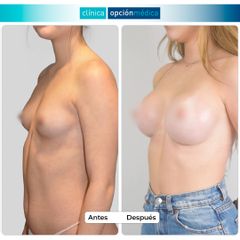 Aumento de pecho - Clínica Opción Médica