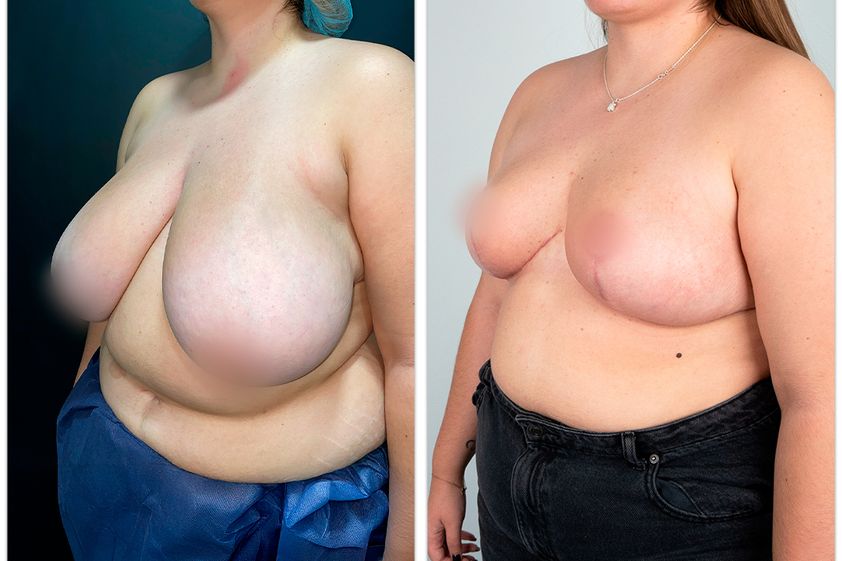Reducción senos antes y después - 877267