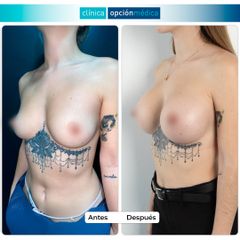 Aumento de pecho - Clínica Opción Médica