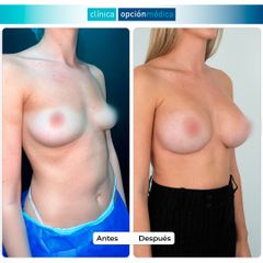 Aumento de pecho - Clínica Opción Médica