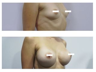 Antes y despues aumento de pecho