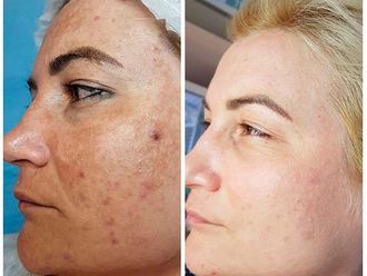 Peeling - 636182