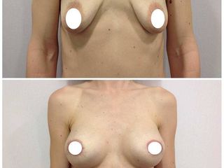 Aumento de pecho: mastopexia periareolar