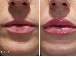 Aumento de labios con perfilados
