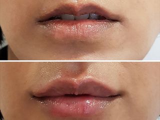 Aumento de labios 