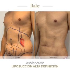 Liposucción Alta Definición