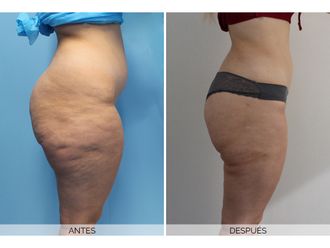 Lipedema antes y después - 701322