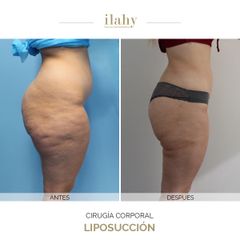 Liposucción - Dr. Alberto Pérez - Ilahy Instituto Dermoestético