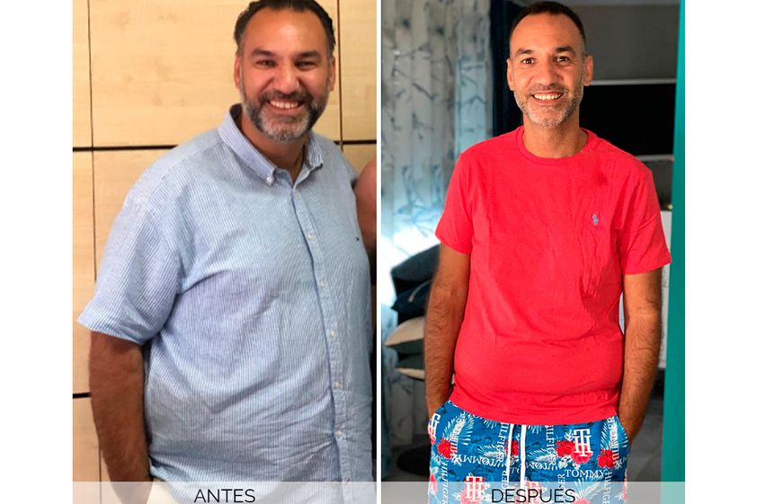 Reducción de estómago antes y después - 701323
