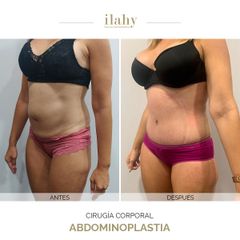 Abdominoplastia - Ilahy Instituto Dermoestético