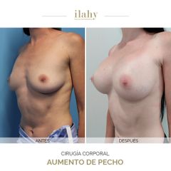 Aumento de pecho - Ilahy Instituto Dermoestético