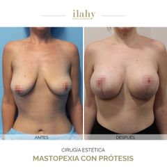 Mastopexia con prótesis - Ilahy Instituto Dermoestético