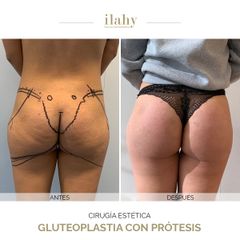 Gluteoplastia con prótesis - Ilahy Instituto Dermoestético