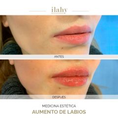 Aumento de labios - Dra. Artemenko - Ilahy Instituto Dermoestético