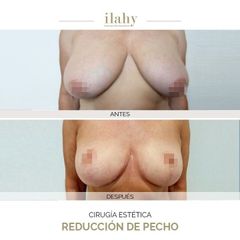 Reducción de senos - Ilahy Instituto Dermoestético