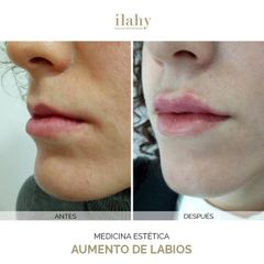 Aumento de labios - Ilahy Instituto Dermoestético