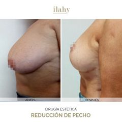Reducción de senos - Ilahy Instituto Dermoestético
