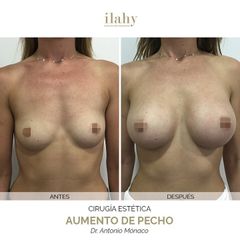 Aumento de pecho - Ilahy Instituto Dermoestético