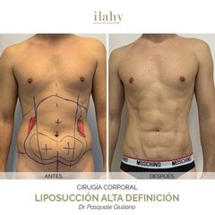 Liposucción - Ilahy Instituto Dermoestético