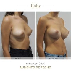 Aumento de pecho - Ilahy Instituto Dermoestético