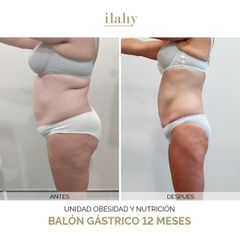 Balón gástrico - Ilahy Instituto Dermoestético