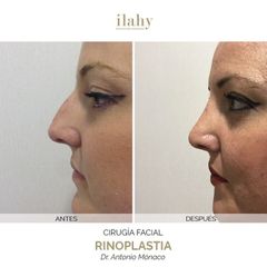 Rinoplastia - Ilahy Instituto Dermoestético